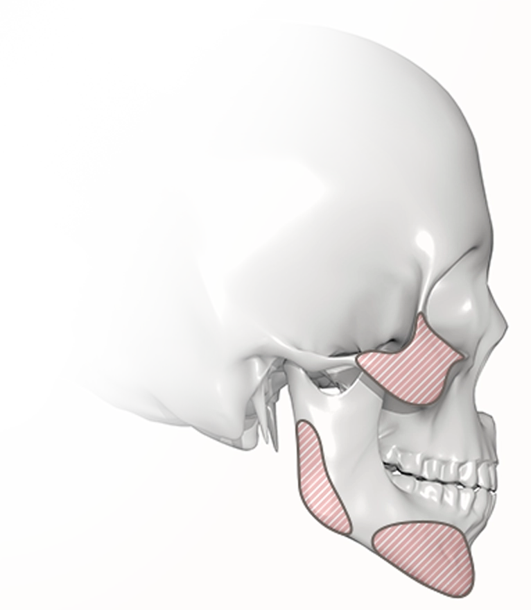 顔面骨格の斜めからのイラスト。頬骨、顎などピンクの斜線で強調。345 Plastic Surgeryが提供する、顔の輪郭を整える美容整形手術のイメージ。