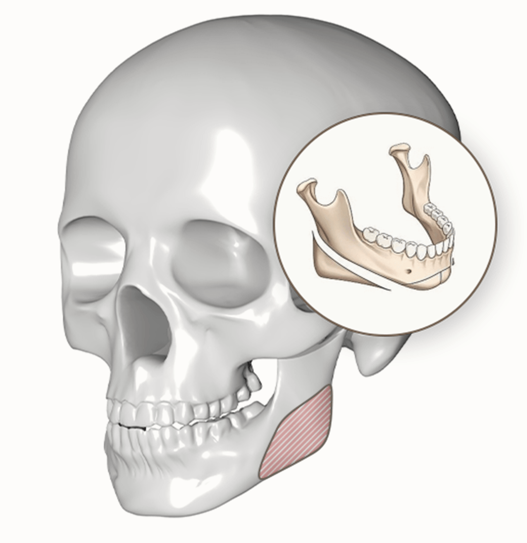 頭蓋骨のイラスト。顎の骨格を円で拡大表示。345 Plastic Surgery関連。顔の骨格矯正や輪郭形成手術のイメージ。美容整形外科での顎の整形手術を検討する際の参考資料。