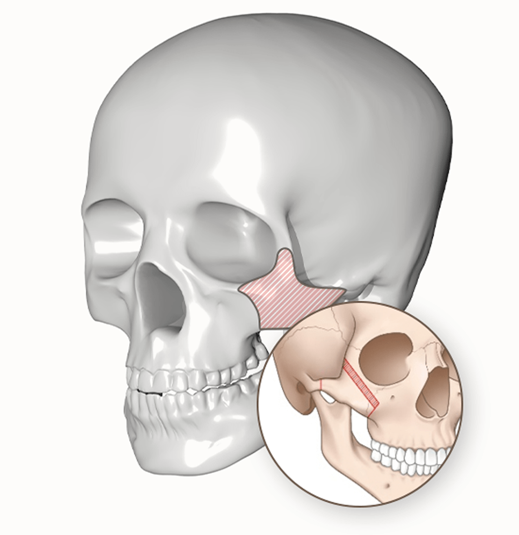 頭蓋骨のイラスト。頬骨部分に斜線。頬骨形成手術の解説図か。345 Plastic Surgery。顔の輪郭形成や骨格矯正など美容整形に関心のある方へ。