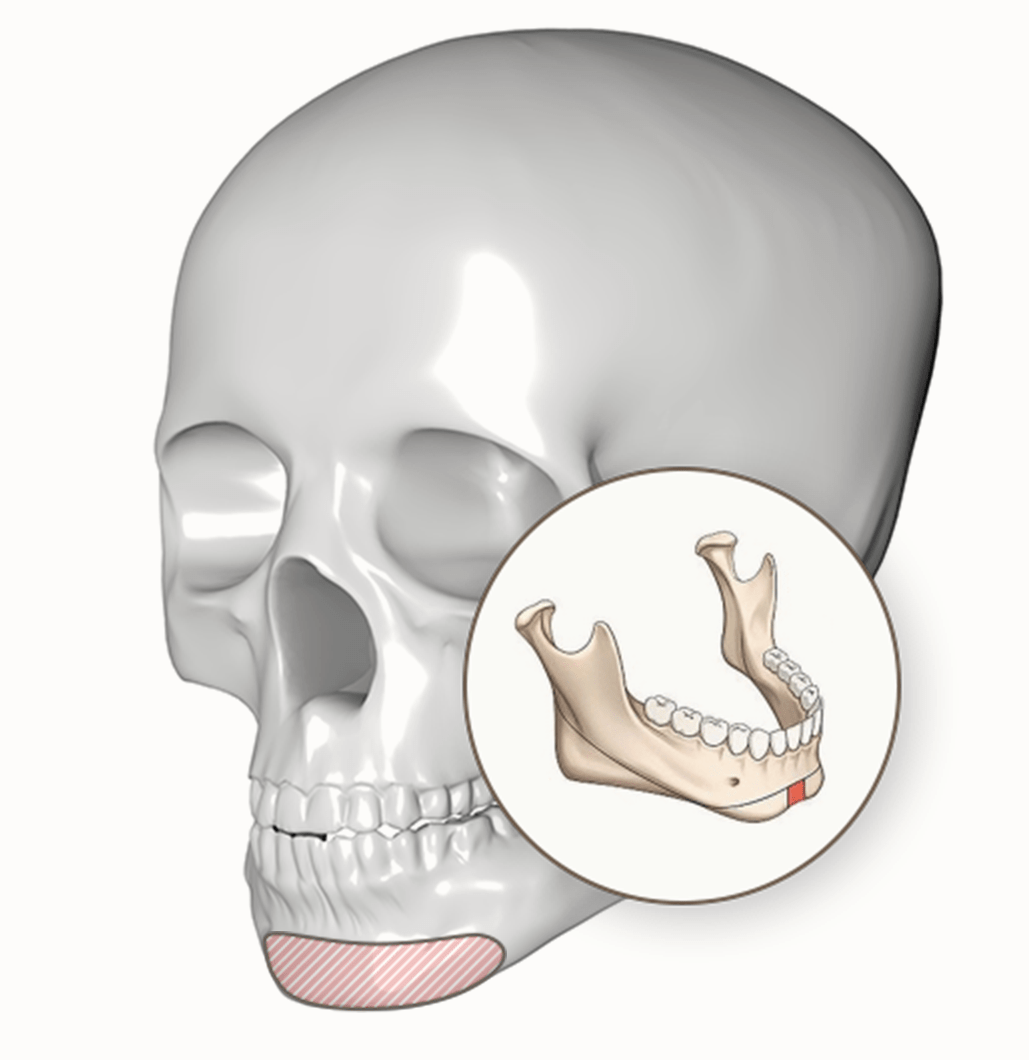 人間の頭蓋骨のイラスト。顎部分にフォーカスし、345 Plastic Surgeryで提供される顎の整形手術を解説。顔の骨格矯正や美容整形に関心のある方へ。