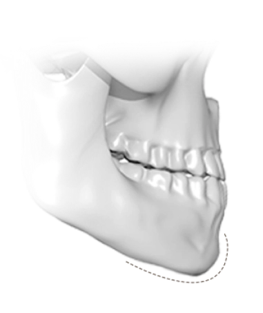 345 Plastic Surgery。下顎骨の3Dレンダリング画像。輪郭形成手術のシミュレーションを示唆。骨格構造、歯並び、顎先の形状が詳細に描写され、美容整形手術による変化の可能性を表現。