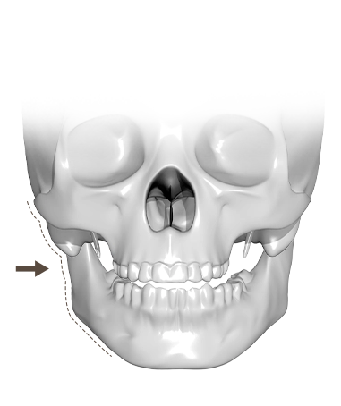 顔面骨格の3Dレンダリング画像。矢印で示された輪郭線は、345 Plastic Surgeryで提供される美容整形手術の範囲を示す。顔の骨格矯正、輪郭形成のイメージ。