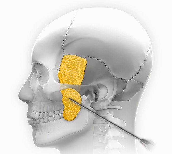345 Plastic Surgery。顔の骨格図、黄色で示されたバッカルファット、除去手術の様子。小顔整形、頬の脂肪除去に関心のある方へ。