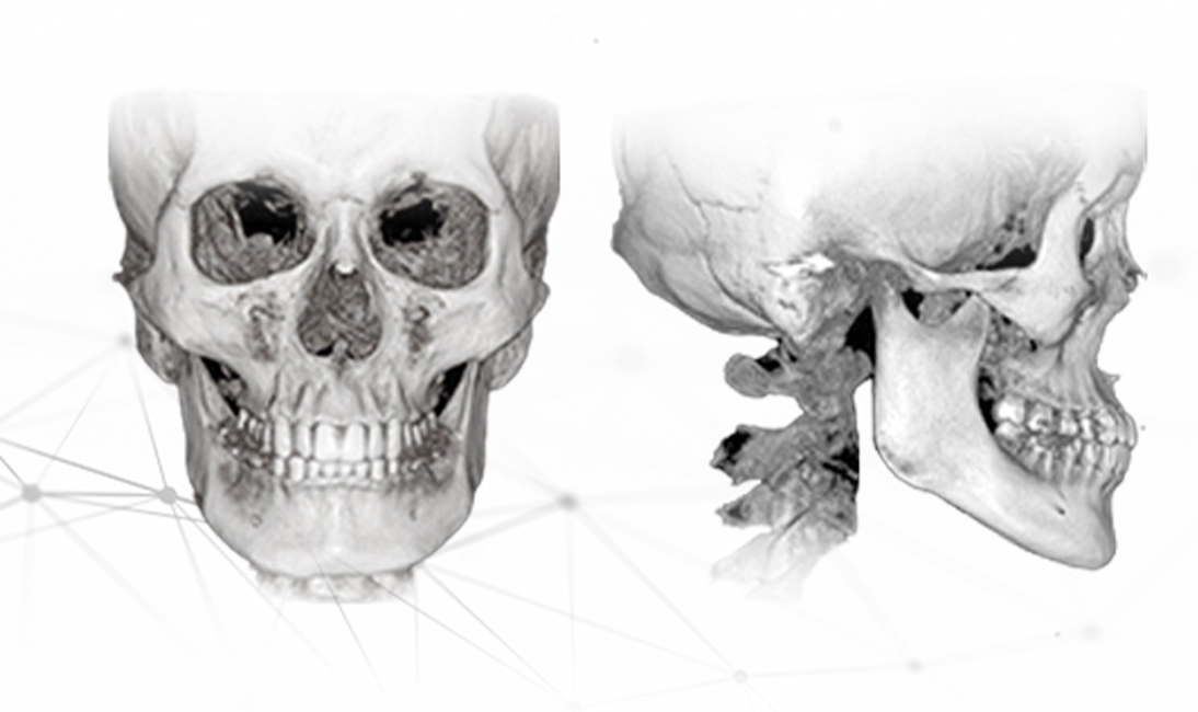 顔面骨格の3Dレンダリング画像。正面と側面からのビュー。345 Plastic Surgeryでは、顔面輪郭の整形手術も行っています。顔の骨格構造を理解することは、美容整形において重要です。
