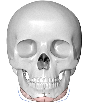 正面から見た人間の頭蓋骨の図。顎に整形手術のマーキング。345 Plastic Surgeryは、顔の輪郭を整える顎の整形手術を提供。顔の骨格矯正、小顔効果、美容整形に関心のある方へ。