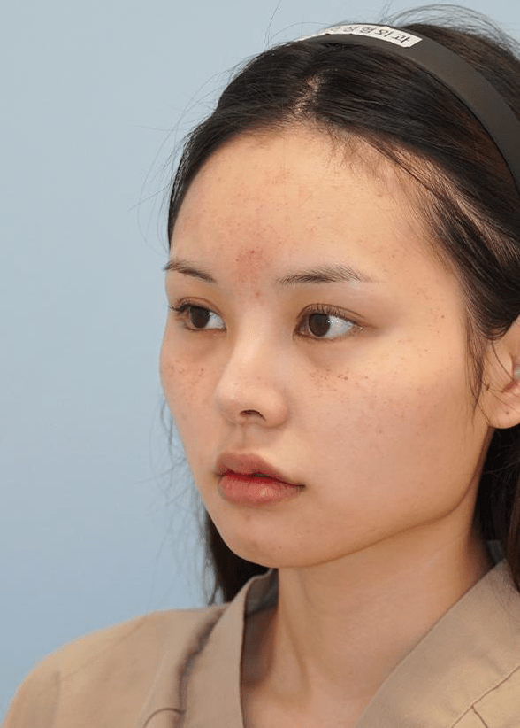 顔のそばかすが目立つ若い女性。345 Plastic Surgeryの美容整形を検討中か。肌の質感、顔の輪郭、パーツのバランスが確認できる。施術前の状態を示す参考画像。