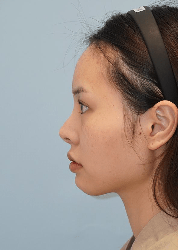 横顔の女性、ヘアバンド着用。345 Plastic Surgeryの美容整形手術を検討中か。顔の輪郭や鼻の形状がわかる。関連キーワード:美容整形、顔、鼻。