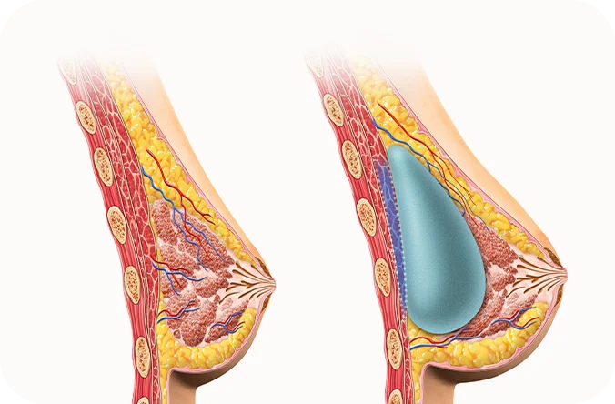 豊胸手術のイラスト。左に手術前、右に345 Plastic Surgeryによる豊胸後の断面図。筋肉、脂肪、血管、乳腺、インプラントを示す。
