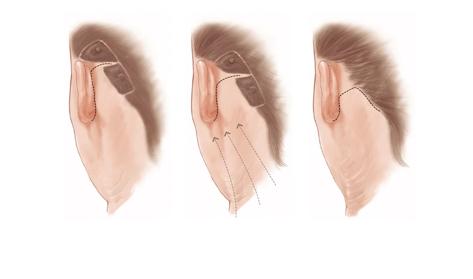 345 Plastic Surgeryイラスト。フェイスリフト手術のステップを3段階で図示。切開ライン、リフト方向、術後の状態を示す。美容整形による若返り効果のイメージ。