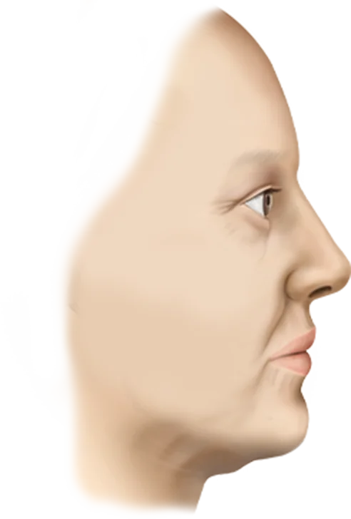 Submental Corset Platysmaplasty,Double Chin Surgery,Jawline Lifting,Neck Wrinkle Correction,Facial Contouring