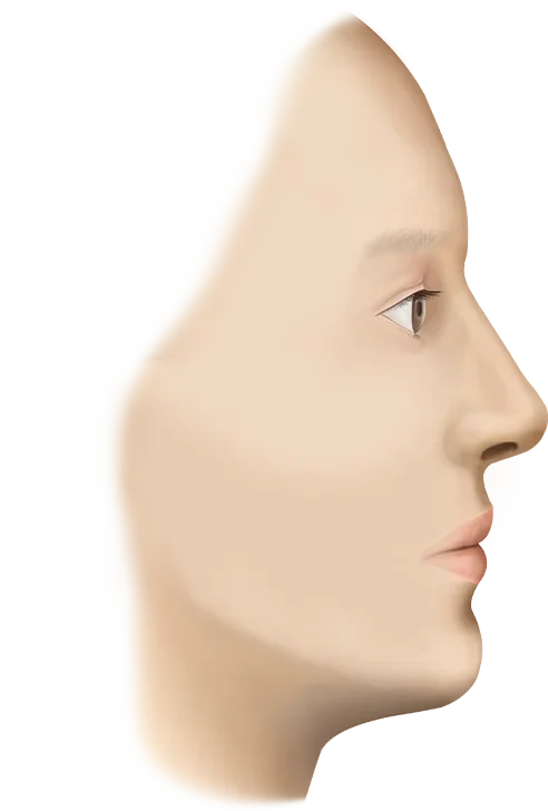 Submental Corset Platysmaplasty,Double Chin Surgery,Jawline Lifting,Neck Wrinkle Correction,Facial Contouring