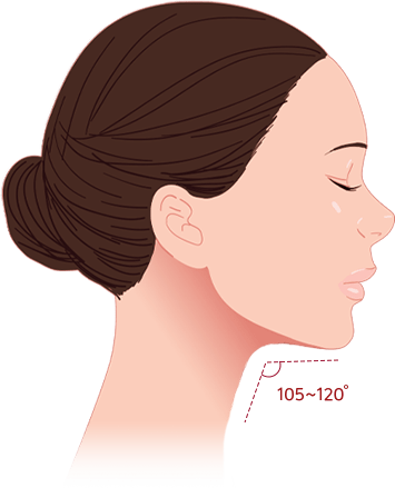 Submental Corset Platysmaplasty,Double Chin Surgery,Jawline Lifting,Neck Wrinkle Correction,Facial Contouring
