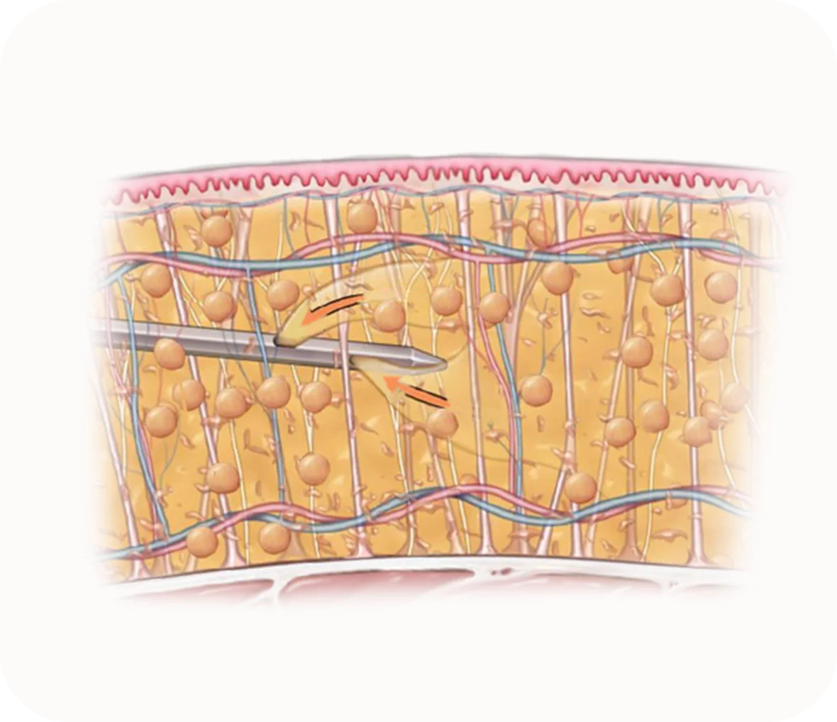 Submental Corset Platysmaplasty,Double Chin Surgery,Jawline Lifting,Neck Wrinkle Correction,Facial Contouring