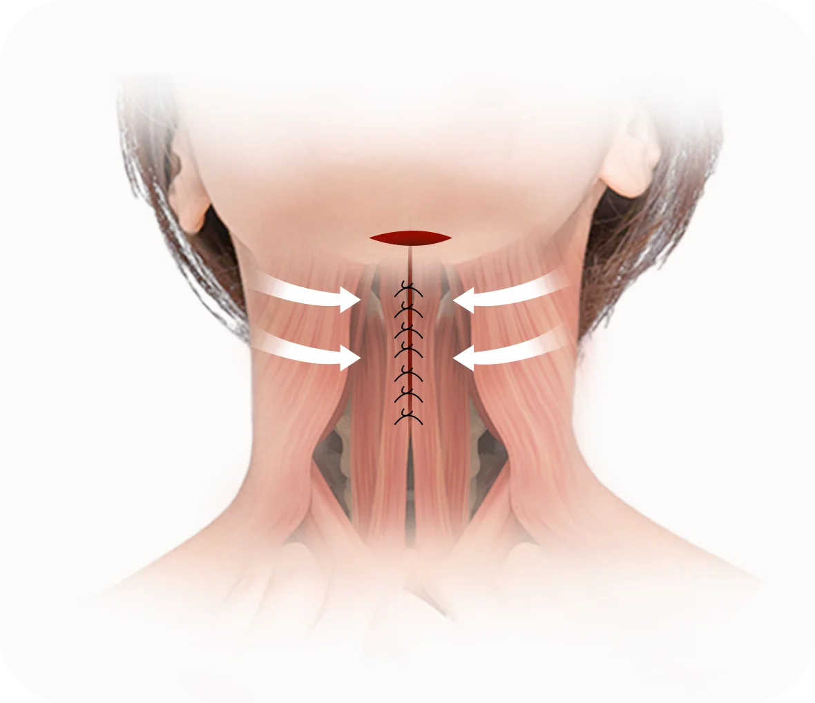 Submental Corset Platysmaplasty,Double Chin Surgery,Jawline Lifting,Neck Wrinkle Correction,Facial Contouring