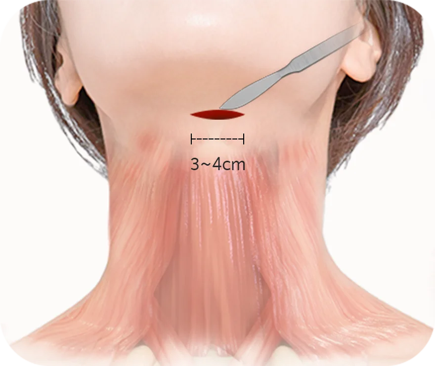 Submental Corset Platysmaplasty,Double Chin Surgery,Jawline Lifting,Neck Wrinkle Correction,Facial Contouring