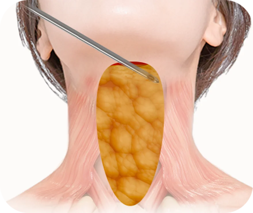 Submental Corset Platysmaplasty,Double Chin Surgery,Jawline Lifting,Neck Wrinkle Correction,Facial Contouring