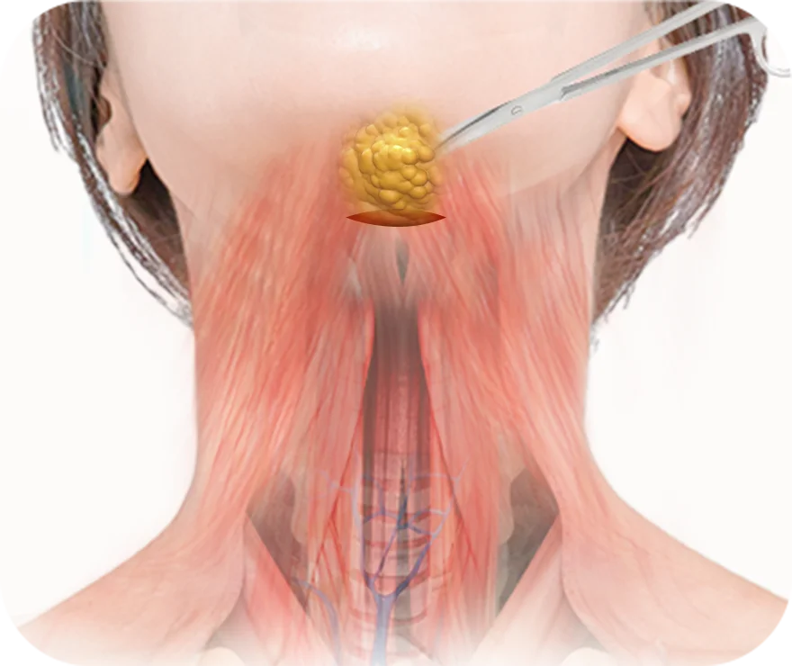 Submental Corset Platysmaplasty,Double Chin Surgery,Jawline Lifting,Neck Wrinkle Correction,Facial Contouring