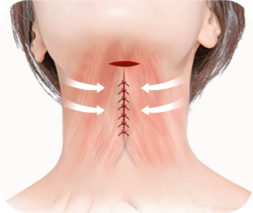 Submental Corset Platysmaplasty,Double Chin Surgery,Jawline Lifting,Neck Wrinkle Correction,Facial Contouring