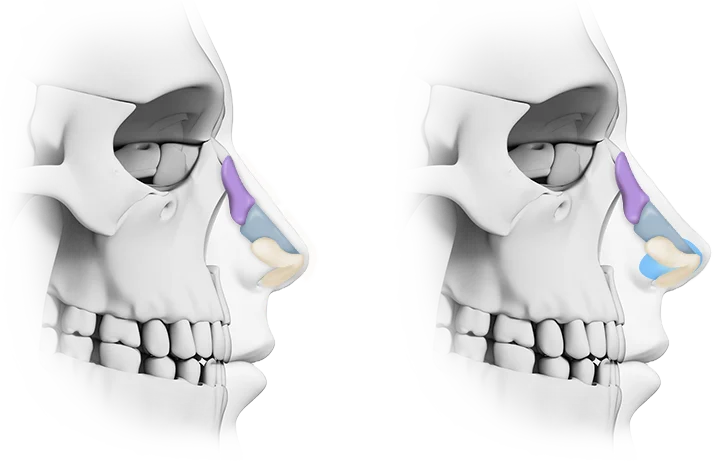 顔面骨格のイラスト。鼻の構造を色分け表示。345 Plastic Surgery提供の鼻整形手術に関する情報。美容整形、鼻の構造理解に役立つ。