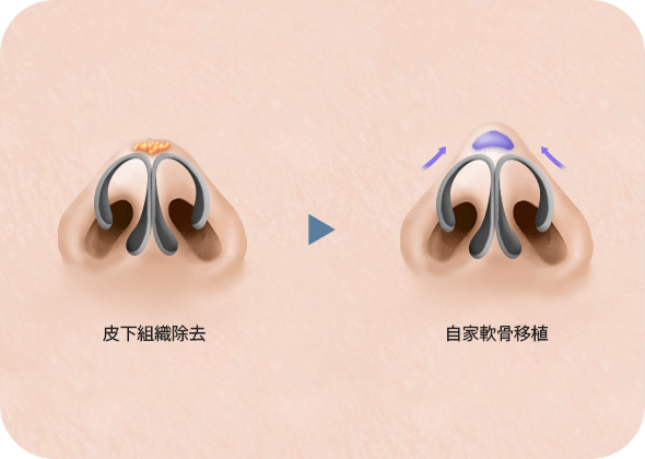 鼻の手術手順図解