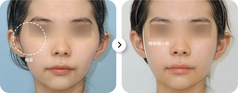頬骨縮小手術のビフォーアフター