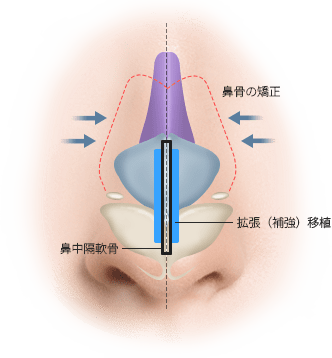 鼻の構造と矯正手術図解