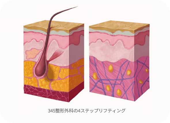 肌の断面図、リフティング効果