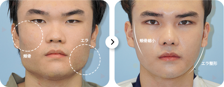 男性の顔の輪郭整形ビフォーアフター。345 Plastic Surgeryでエラ削り、頬骨縮小手術。施術前はエラと頬骨が目立つ。施術後は顔のラインがシャープに。小顔効果。美容整形。