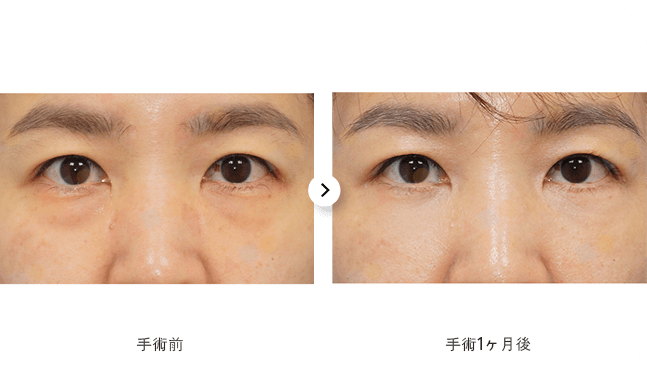 手術前後の目の比較