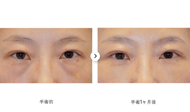 目の手術のビフォーアフター
