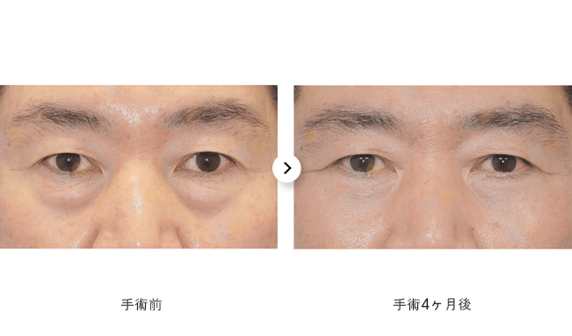 手術前後の目の比較