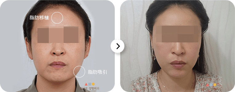 脂肪移植前後の比較写真