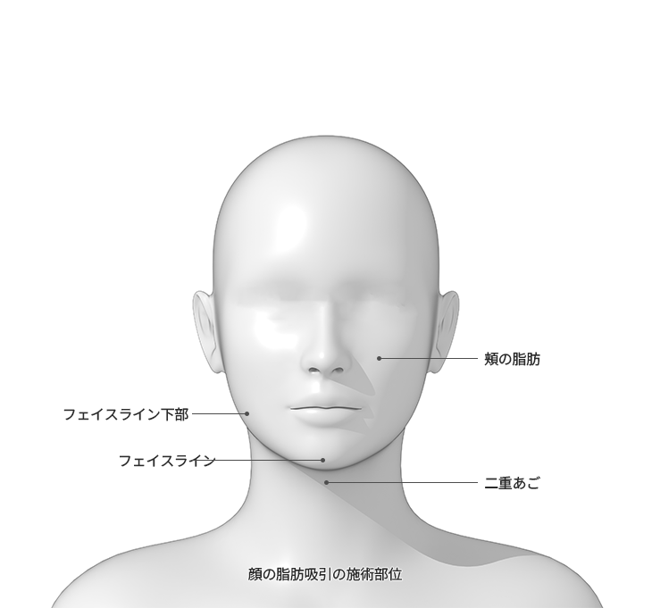 顔の脂肪吸引部位を示す図