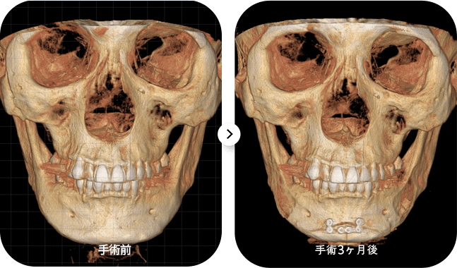 手術前と3ヶ月後のCTスキャン