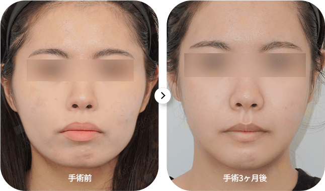 女性の顔の整形手術前後。左が手術前、右が手術3ヶ月後。345 Plastic Surgeryによる施術で、顔の輪郭がシャープに。関連キーワードは小顔、美容整形。