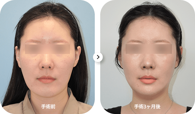 手術前後の女性の顔比較