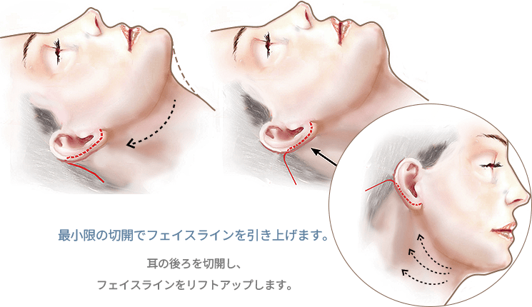 顔のイラスト、フェイスリフト手術の切開線を示す。345 Plastic Surgery。ページタイトル・本文・ファイル名より、美容整形、フェイスライン、リフトアップ関連。