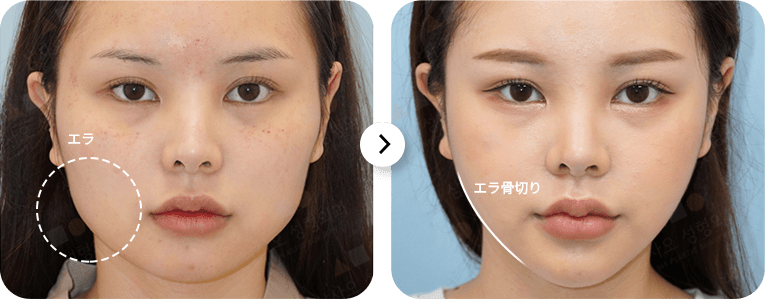 女性の顔の輪郭修正ビフォーアフター。エラ部分に注目。345 Plastic Surgeryによる施術例。美容整形による変化を示す。