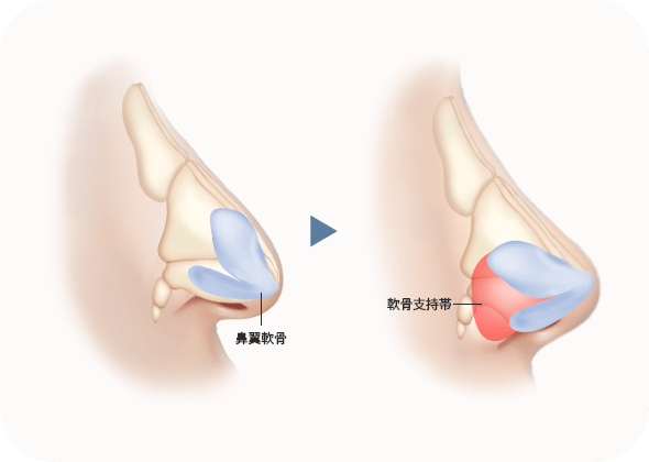 鼻翼軟骨の支持帯強調図