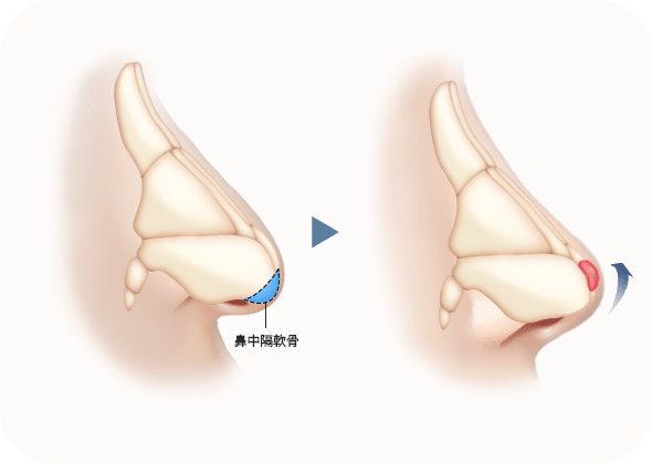 鼻中隔軟骨の整形手術イラスト