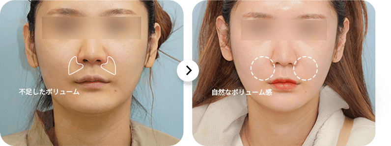 顔のボリューム変化、ビフォーアフター