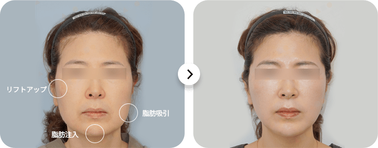 美容施術前後の女性の顔