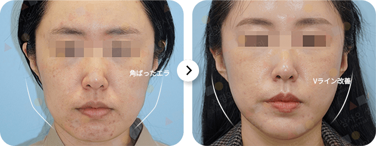 輪郭の変化のビフォーアフター