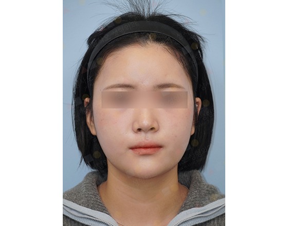 Person wearing a headband with eyes blurred