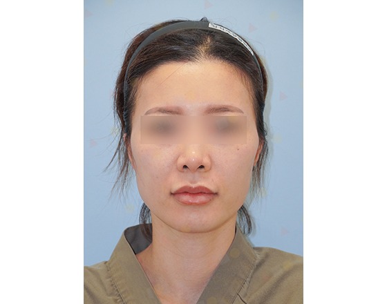 Person with blurred eyes, wearing headband.