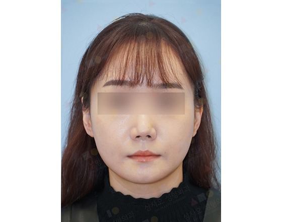 Person with obscured eyes facing forward
