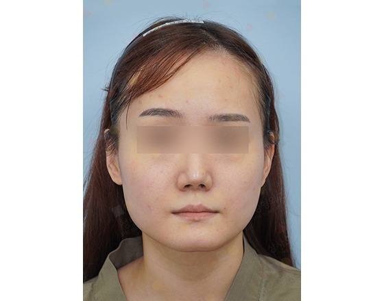Front view of person's face with blurred eyes.