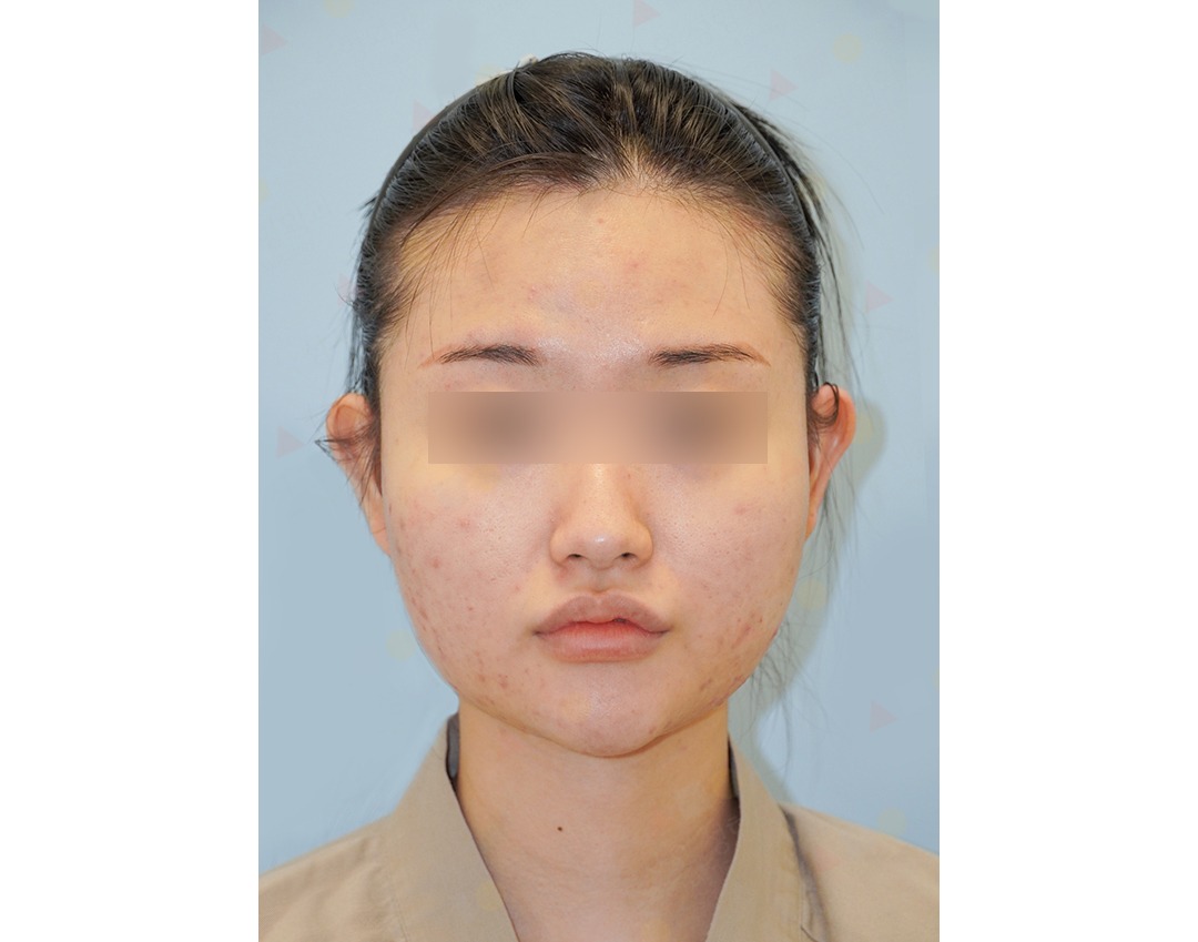 Person with acne and blurred eyes, neutral expression.