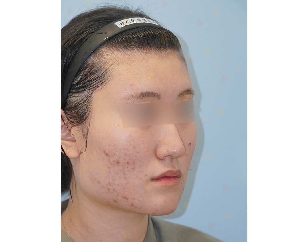 Person with acne on face, side profile view.