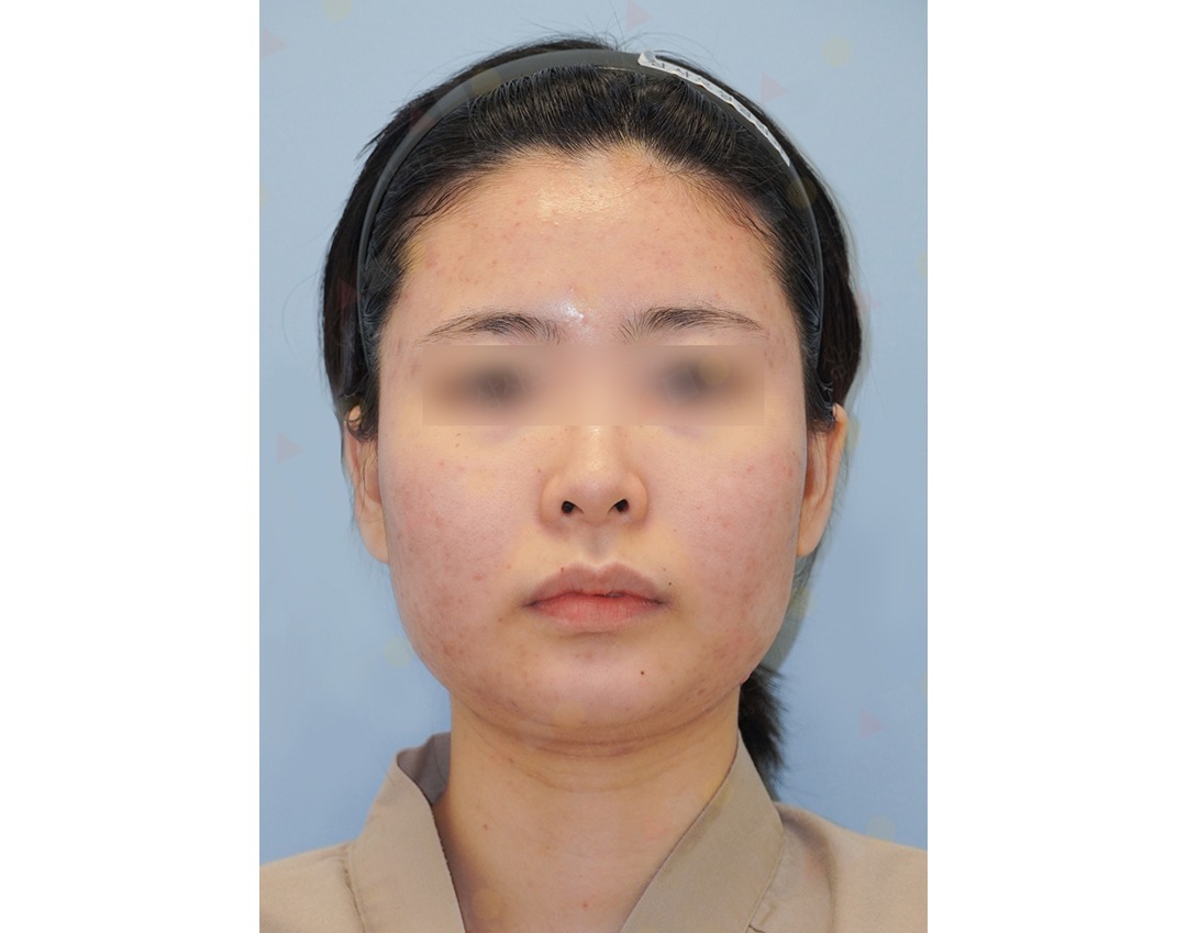 Person with skin condition, headband, neutral expression